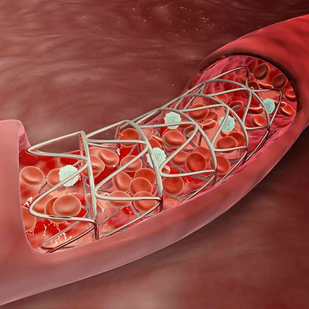 The Benefits of Early Detection in Angina Management