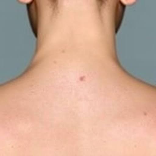 The Role of Mohs Surgery in Preventing Skin Cancer