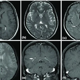 What Is Neuroradiology and Why It Matters for Your Health